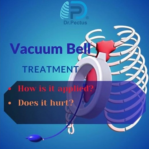 Vacuum Bell Treatment (Pectus Excavatum)