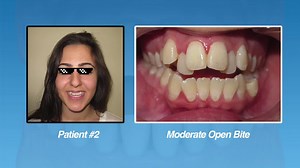 類 How Do Braces Fix Open Bites? Open bites are a common problem orthodontists see every day. In this video, we’ll discuss 3 specific ways that open bites are corrected with braces. Then we’ll go into the process behind each method! To learn more about Open Bites or to get started with braces, check out the following articles on our website: Why Adults Need Braces: https://yourazbraces.com/adult-braces/why-adults-need-braces/ | Premier Orthodontics | Facebook