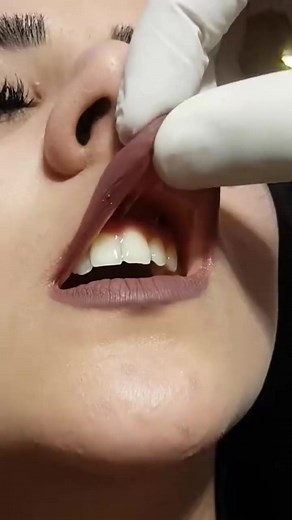 14K views · 76 reactions | The Smiley Piercing Procedure #piercing #smileypiercing #smileypiercings #smileypiercingvideo #piercingeducation #piercingcare #education | piercing.world | Facebook