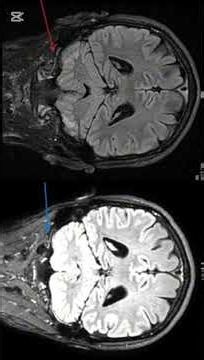 MRI Before–After Comparison: Documented Structural Changes Over Time