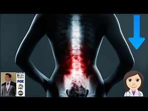 Adjacent Segment Disease (ASD) after Spinal Fusion Surgery from the Injury Lawyers / Attorney FAQs