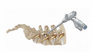 Laser Endoscopic Spine Surgery (LESS) | Excel Spine