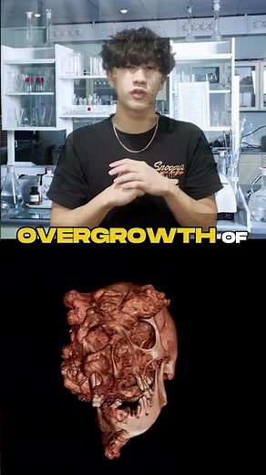 The Tragic Tale of The Elephant Man! Proteus Syndrome