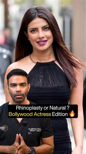 Rhinoplasty or Fillers? Doctor Breaks Down Celebrity Nose Transformations