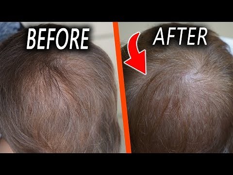 Topical Finasteride - 1 month Update! Only one side effect...