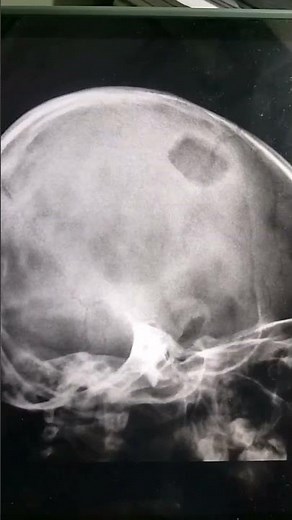 punch out lytic lesion seen in langer han cell histiocytosis #radiology