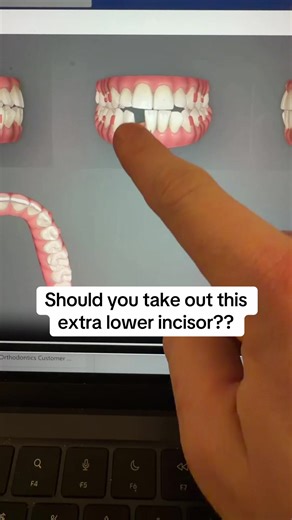 Managing Extra Teeth: Extraction vs. IPR Decisions