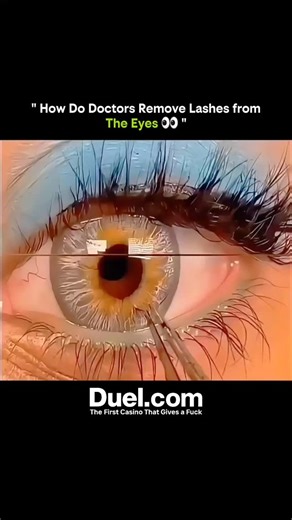 SCIENCE - EXPLAINED | 👁️ How Doctors Safely Remove Lashes from the Eyes Sometimes, an eyelash or small foreign object gets stuck in the eye — it’s uncomfortable... | Instagram