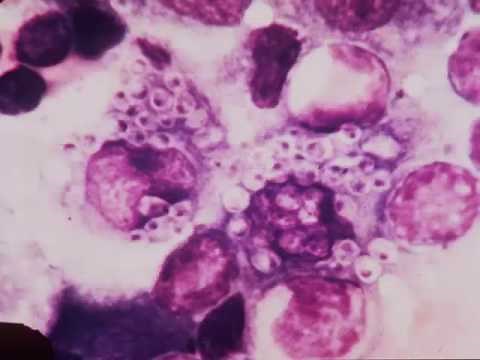 Clinical Mycology: Direct Examination Series: Histoplasma [Hot Topic]
