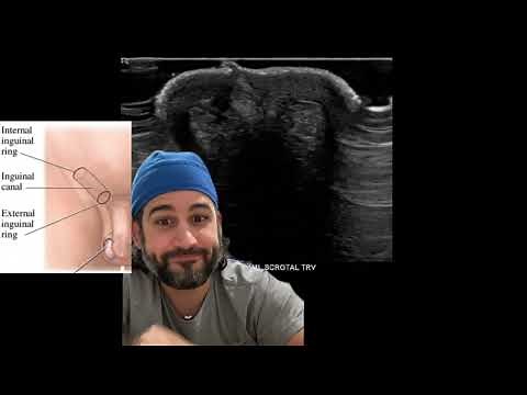 Retractile Testes