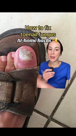 Effective Home Remedies for Toenail Fungus Treatment