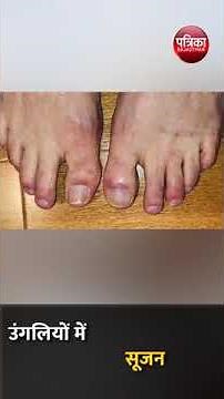 जानें क्या है Covid Toes