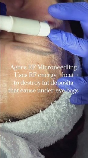 How to Treat Under-eye Bags without Surgery #eyebags #skincare #skincareroutine #skincaretips