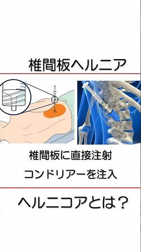 How does HERNICORE work? How is it treated? [Doctor's explanation] #Sciatica #SpinalStenosis #Her...