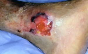 Types of Wounds: Venous wounds: Physical findings