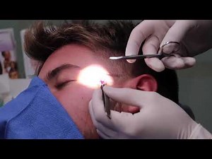 Man gets cyst removed from face