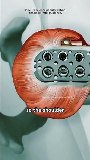 roximal Humeral Plating Surgery Explained in 60 Seconds (Medical 3d Animation)