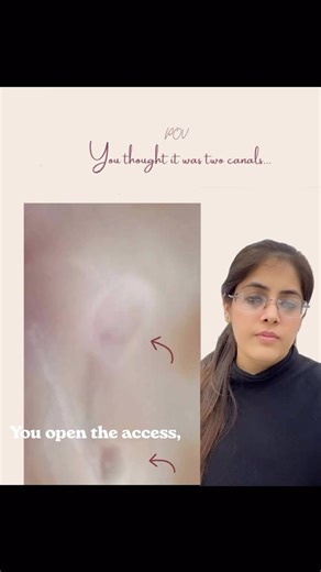 Ritika Satija on Instagram: "Most “extra canals” aren’t extra canals👀 Two bleeding points can look convincing—but in oval canals, incomplete unroofing and dentin shelves often create false divisions, making one canal appear as two. Even if both are shaped, remember: 🔄 Rotary files are circular ➡️ The isthmus remains untouched ➡️ Pulp tissue and debris persist ➡️ Reinfection and RCT failure follow Once the access is properly refined, the truth is revealed—one true oval canal. Circumferential fi