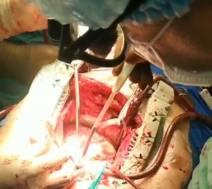 Chest Surgery To Remove Shrapnel (part 2)