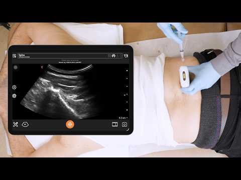 Ultrasound-Guided L5-S1 Facet and Cluneal Nerve Injections