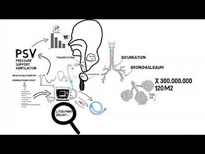 Invasive Beatmung by immerda