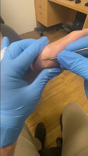 Extreme Foot Transformation Deep Pinch Callus Removed by Podiatrist #FootCare #CallusRemoval