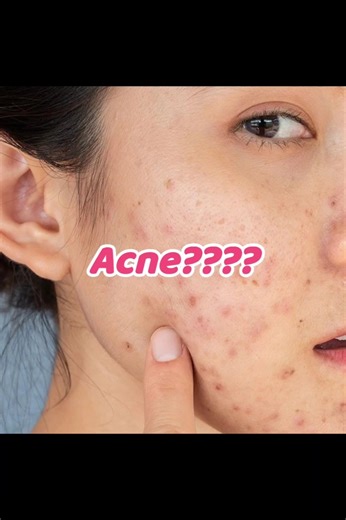 best face scrub for oily acne skin😱🔥| #skincare #oilyskin #acne #scrub #beauty #fyp #magic #skincare
