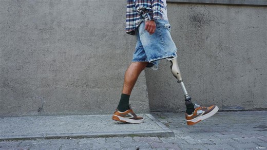 Affordable prostheses with innovative 3D printing