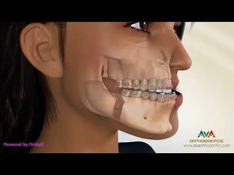 Surgical Orthodontic Treatment for Underbite or Crossbite - Transcortical Mandibular Setback