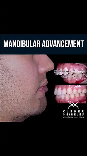 MANDIBULAR ADVANCEMENT - ORTHODONTIC TIPS #Shorts