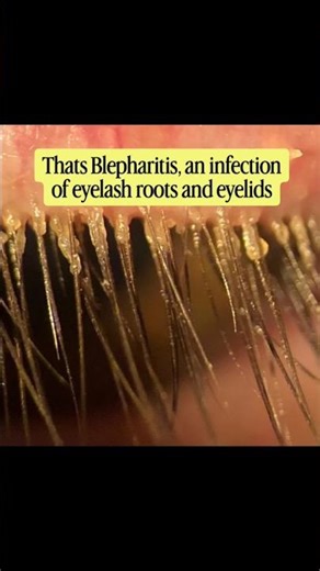 Itchy eyelids with red eyes and watering could be causing permanent harm to your eyes #blepharitis