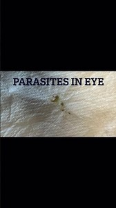 How To Get Rid Pf Parasites In The Eyes. Alkaline Herbs and Recipes