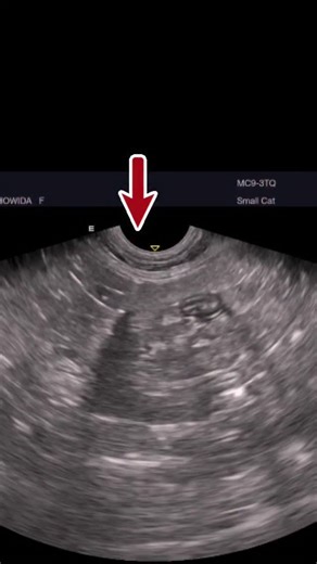 Ahmed Hammam | Free gas in the abdomen—medically termed pneumoperitoneum—is the presence of air or gas within the peritoneal cavity outside the... | Instagram