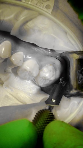 Upper Wisdom Tooth Extraction Explained