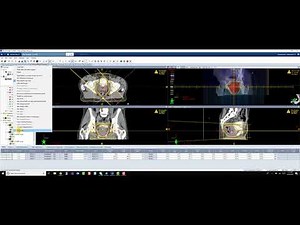Varian Eclipse 3 Field (Mercedes) Technique