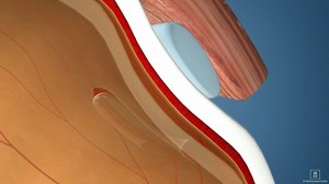 Scleral Buckling: Overview