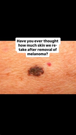 RIVERSIDE SKIN & LASER CLINIC | CHELMSFORD on Instagram: "🌟 A wide local excision (WLE) for melanoma is a standard surgery to remove the original cancerous spot plus a surrounding border of healthy-looking skin and tissue to reduce recurrence risk. ‼️ The margin size (e.g., 0.5cm to 2cm) depends on the melanoma’s thickness (Breslow thickness) and location, aiming for clear margins. 🌟 Usually done under local anesthetic as an outpatient procedure, it involves stitching the wound closed or somet