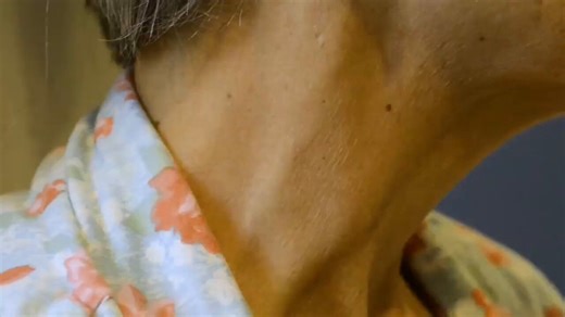 A 57-year-old woman with a dual-chamber pacemaker presents with edema, ascites, and rapid weight gain.On exam, there is a pansystolic murmur that increases with inspiration and prominent systolic JVP pulsations.What is the underlying diagnosis?