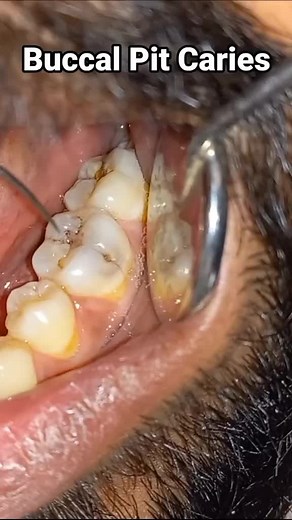 Understanding Tooth Decay: Causes, Symptoms, and Treatments