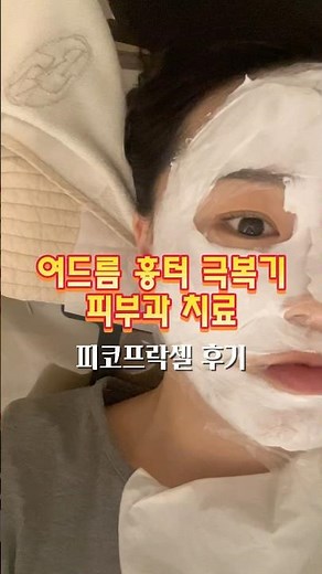 여드름 흉터 치료 피코프락셀 후기 #여드름 #흉터치료 #피코레이저 #피부과 #피부시술