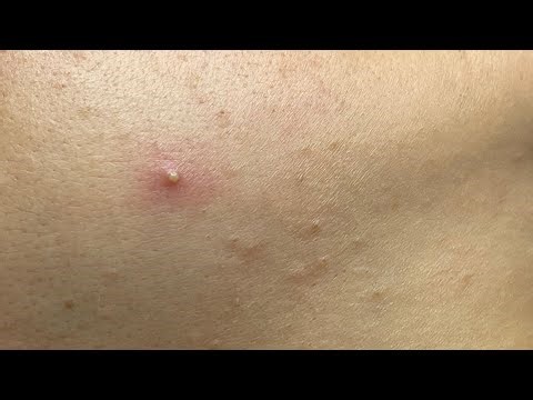 Relaxing Acne Cleansing with LinhMyDang #596