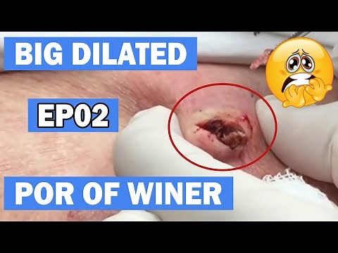 Blackheads Two Big Dilated Pores of Winer EP02!!