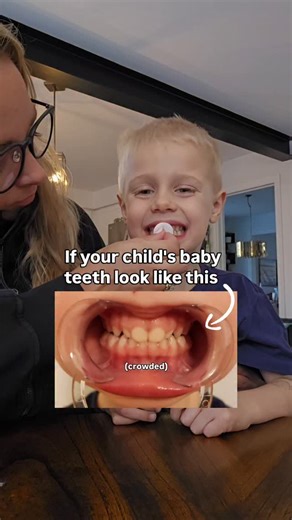 This is my son. We were always told everything was fine — his teeth, his breathing, his sleep. But in reality, there were so many little signs we didn’t realize were connected… enlarged tonsils, mouth breathing at night, snoring, bedwetting, teeth grinding. When I learned how much those things tie back to how the mouth and face grow, it completely changed how I looked at his ‘crowded baby teeth.’ The earlier you start supporting proper muscle function and breathing, the easier it is to guide hea