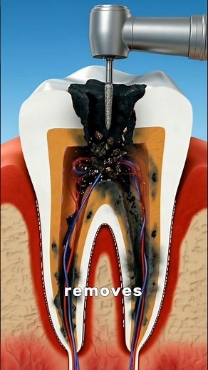 What Happens During A Cavity Filling? 😳