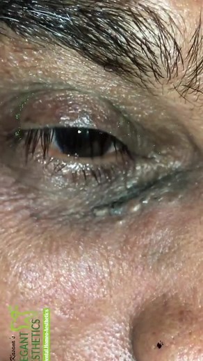 pimplepoppersatisfying su TikTok