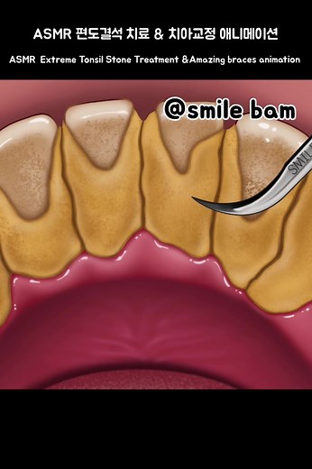 #smilebam #애니메이션 #asmr #care #satisfying #soonent #tonsilstones #braces
