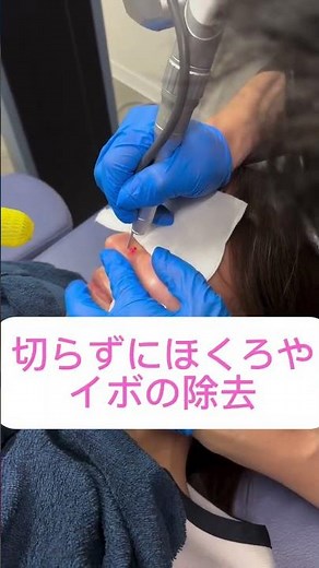 【切らずに】ほくろやイボの除去