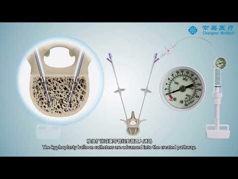 3D Demonstration of Percutaneous Kyphoplasty-11G version