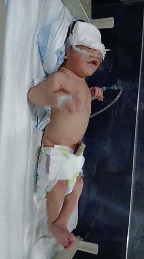 Seizure in Newborn | What to Do When Baby Has Continuous Fits#newbornbaby #babycare #baby#newborn