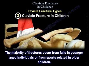 Clavicle Fractures In Children - don't worry the outcome is usually good.
